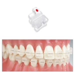 Brackets estetici in ceramica